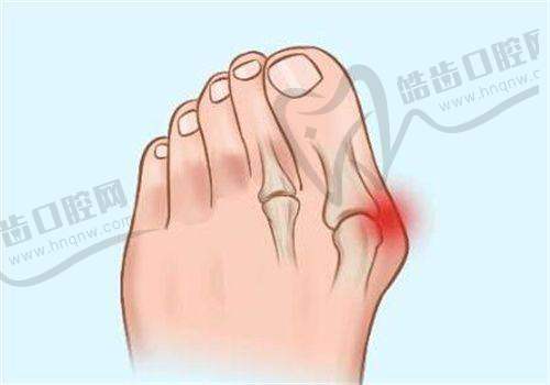 舒铂超肋鼻与肋骨鼻对比，术后成效和成本差异几何？