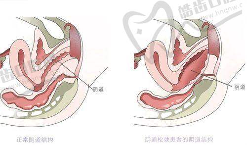 法芮娅假体OC系列适合平胸女性的适用性