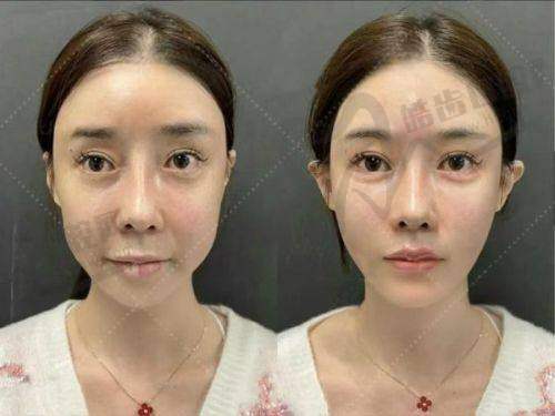 laviv自体成纤维细胞价格的未来趋势预测
