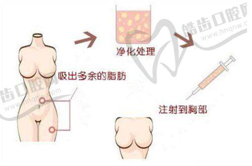 laviv自体成纤维细胞不同渠道价格差异