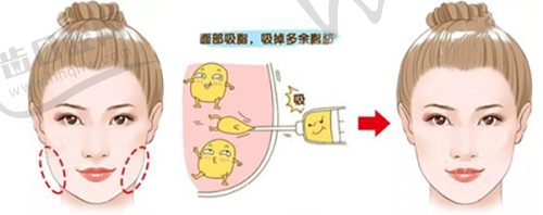 从适合人群看假体垫眉弓和玻尿酸注射眉弓哪个好