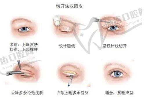 假體隆胸取出后做脂肪隆胸：特殊情況的手術(shù)時(shí)間