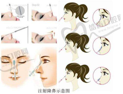 laviv自体成纤维细胞各步骤价格明细