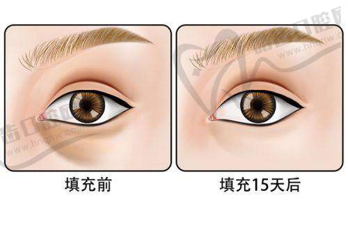 魔滴假體是哪個(gè)國(guó)內(nèi)的：產(chǎn)品優(yōu)勢(shì)剖析