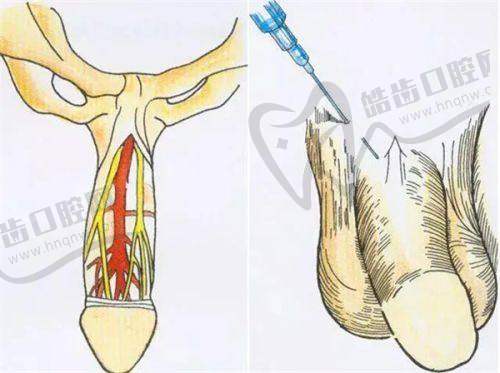 不同原因导致的假体取出挛缩成朝天鼻修复方法
