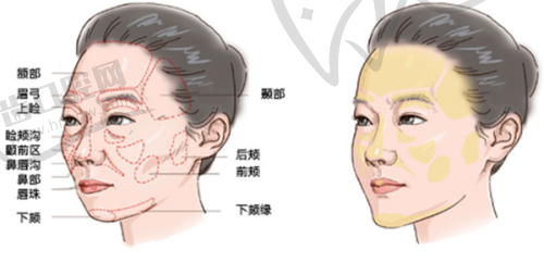 法芮娅假体适合平胸女性的形状角度适配性