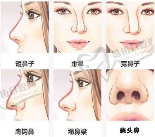 德国宝俪假体：低凸中凸高凸手感差异解析