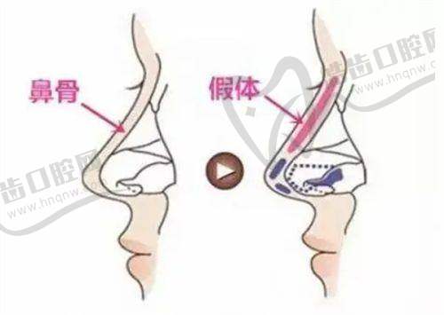 瑞士五点提升针是什么原理之治疗成效能维持多久