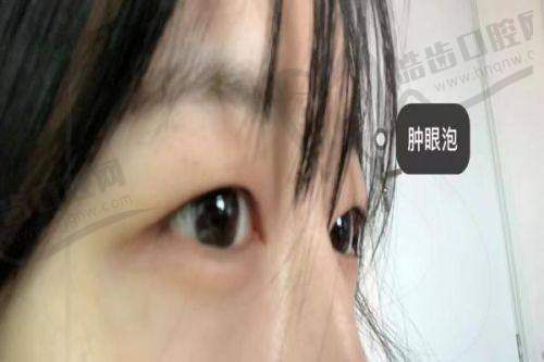 三、杏林杜继凤的技术怎么样？“微创+个性化”，解决“怕留疤”“怕不自然”的痛点
