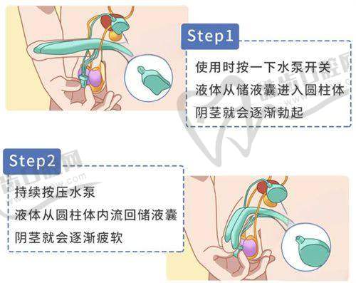 北京嘉禾妇儿医院侯智慧医生3D生物束带紧缩术特点