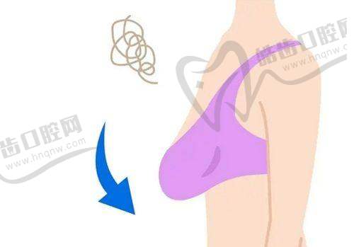 广州曙光谁做鼻子好？王旭明主任膨体隆鼻案例分享，术后效果太惊艳！