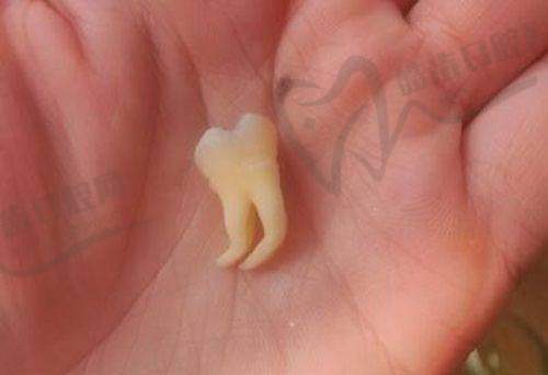 牙齿矫正:让你的笑容更理想