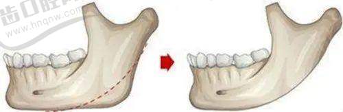 北京侯智慧身体塑形属于什么级别?私密整形名家侯智慧,3D生物束带紧缩术口碑好