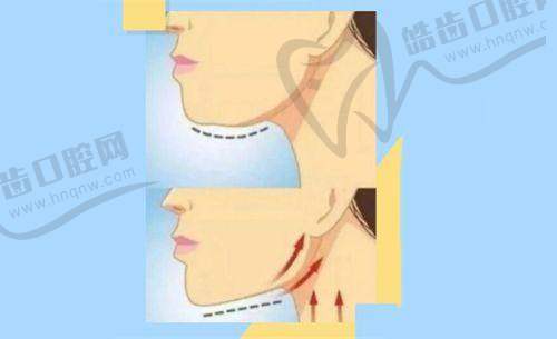 北京嘉禾医疗美容侯智慧医生小阴唇整形术优势