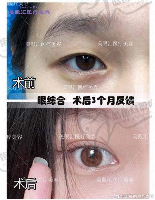 四、杜继凤擅长项目：双眼皮、眼修复、祛眼袋，覆盖全眼部需求