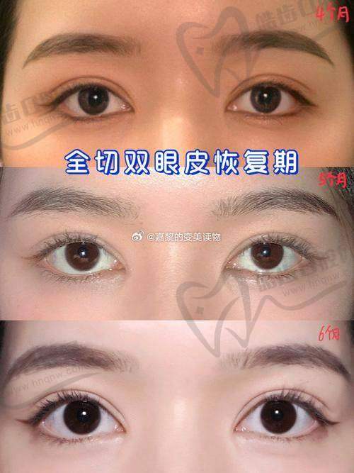 沈阳杏林杜继凤擅长什么？眼综合+修复，把问题眼变成灵动眼