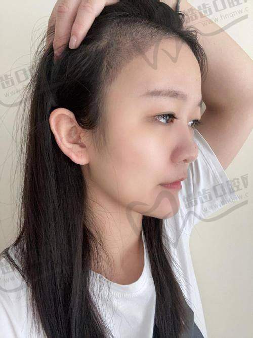 北京袁国安植发医生咋样？技术顶尖擅多项目，方案个性收费合理效果佳