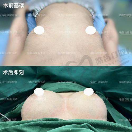 Motiva假体有芯片在术后追踪上的重要意义