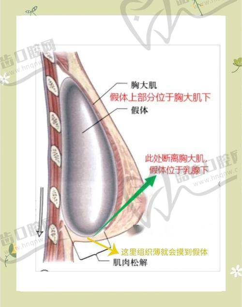 Motiva假体有芯片在患者安心保护上的具体体现