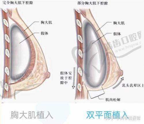 Motiva假体有芯片在真伪鉴别上的显著优势