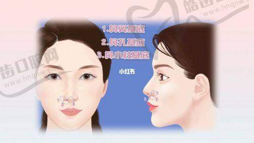 吕方中双眼皮综合多少钱：手术优势与价格合理性