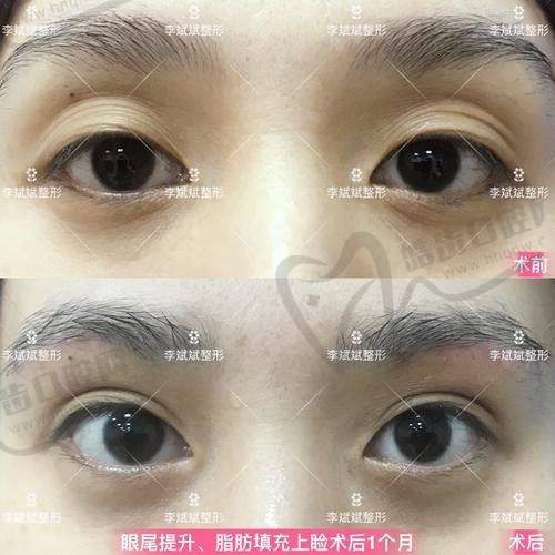 北京刘立强眼部整形医生助理预约，是医学科学院实力派刘立强擅五官美容可在线挂号 
