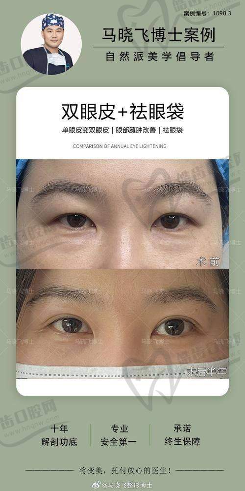北京栾杰眼部整形是什么档次？其隆胸技术卓越且口碑佳，手术收费2万起受认可 