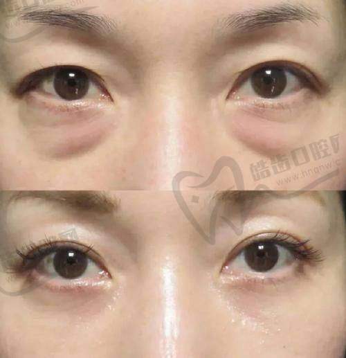 紫洁去眼袋是正规医院吗？看先进祛眼袋技术、合理收费及众多满意顾客评价！
