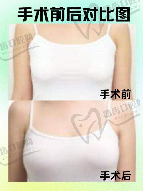 北京纯脂医疗美容门诊部吸脂塑形项目