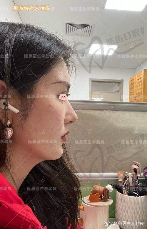 徐航医生的鼻整形技术优势