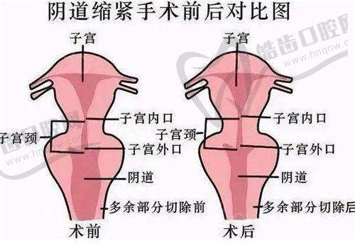 黄金微针选择哪个仪器：从功率角度分析
