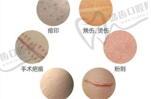 美迪迈黄金微针的价格及其他功效作用解析