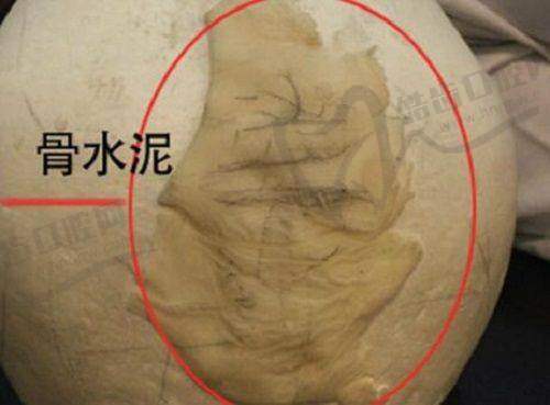 选择半岛逆时针或黄金微针的注意事项及建议