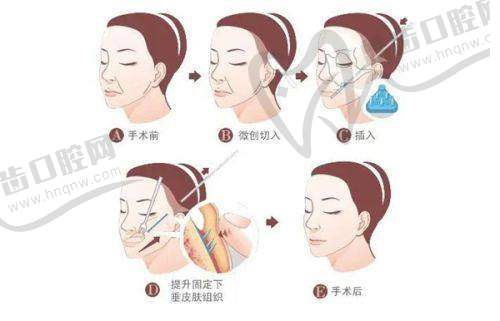 上海華美私密漂紅推薦醫(yī)生——胡小清
