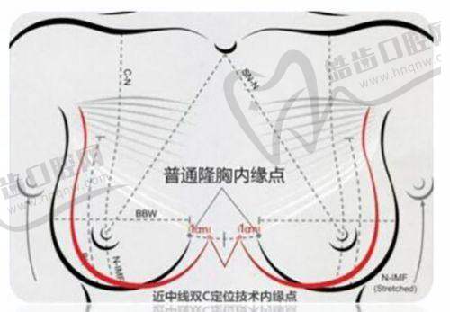 潤致玻尿酸各型號的價格區(qū)間及差異原因