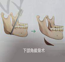 乔雅登玻尿酸正版价格是多少一支——辨别真伪方法