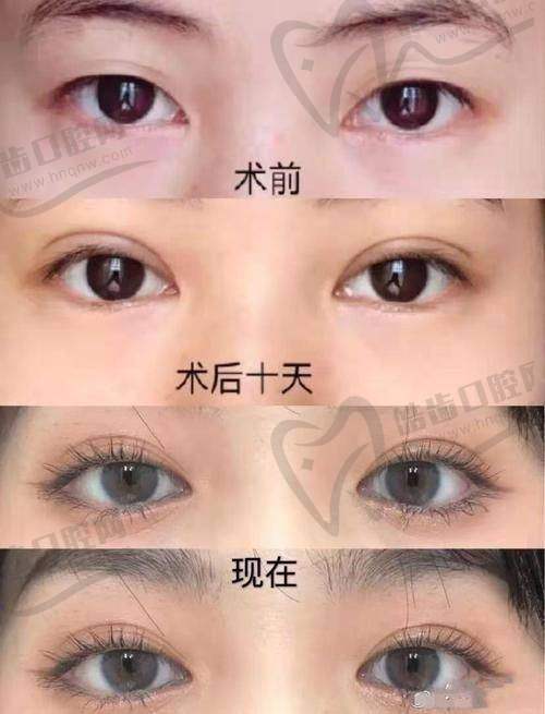2025北京美莱张颖双眼皮修复价格表曝光，案例彰显效果，沟通风格也有看点