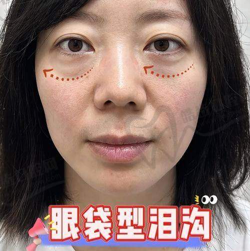 六、总结：蓝奥医美580元祛眼袋是真的吗？是真的，但要知道是“基础版”，想完全解决还得升级