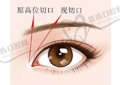 結(jié)語：瑞藍(lán)麗堤安心不變寬，適合高階鼻部精細(xì)化雕刻塑形