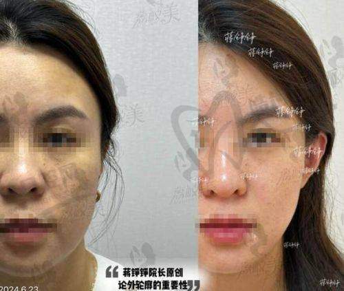 润致娃娃水光针深层补水：疗效成分解析