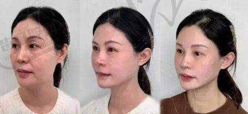 嗨體熊貓針適合注射的第一個(gè)高頻部位：淚溝凹陷
