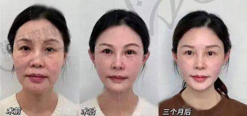 嗨體熊貓針怎么打更有效？搭配方案是關(guān)鍵