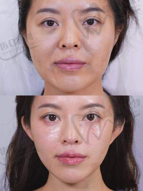 赵祐晟医生擅长的脂肪整形项目