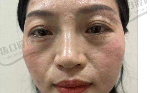 瑞蓝2号玻尿酸有哪些优缺点？选择前务必知晓