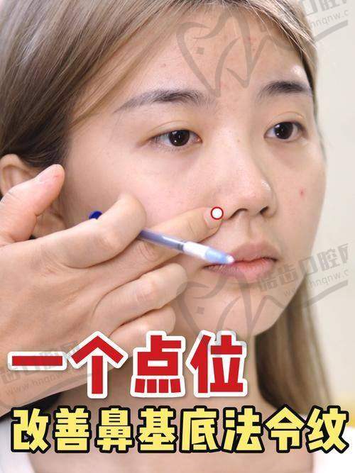 嗨體熊貓針第四適用于眼周細(xì)紋與干燥
