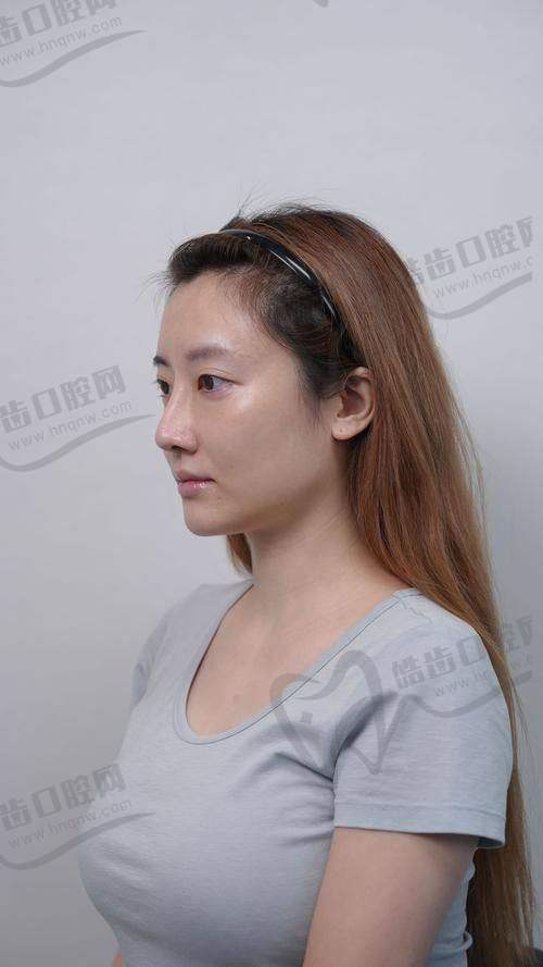 arsmo玻尿酸技术优势：单相交联、多维支撑、利多卡因缓痛配方