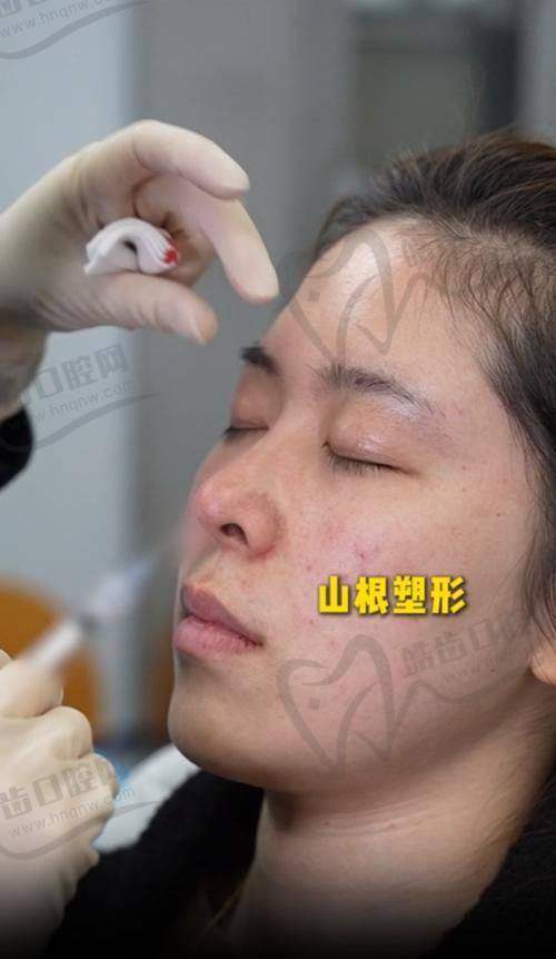 實(shí)際實(shí)例分享：35歲IT女白領(lǐng)淚溝改善前后對(duì)比