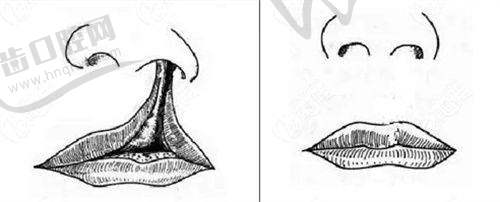 西安艺星乔雅登雅致0.8mL玻尿酸3099元起,徐智慧医生小分子除皱更自然