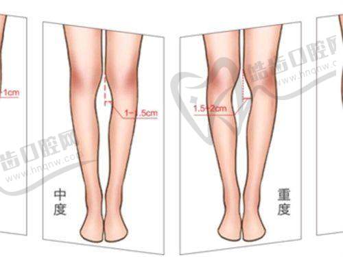 西安艺星姣兰玻尿酸丰唇1mL价格896元起,医生精准注射自然饱满唇形