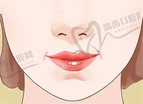 西安艺星海薇M+玻尿酸1mL价格1160元起,徐智慧CC·TV技术填法令纹自然不僵